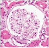 An 8 year old boy was seen by his family physician for sudden weight gain.Otherwise,he was completely well.Upon physical examination,the child had obvious severe peripheral oedema (grade 4+) .Urinalysis showed a markedly increased protein level,but no RBCs.A few fat droplets were seen in the sediment.A renal biopsy was recommended,and the results are shown in the accompanying photomicrograph.The child eventually recovered completely after several doses of systemic corticosteroids.Which one of the following is the best diagnosis?   A) Acute proliferative glomerulonephritis B) Diabetic glomerulosclerosis C) Focal segmental glomerulonephritis D) Membranous nephropathy E) Mesangiocapillary (Membranoproliferative) glomerulonephritis  F) Minimal change disease G) Normal glomerulus H) Rapidly progressive glomerulonephritis (RPGN) 