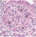 A 28 year old woman with a 7 year history of Systemic Lupus Erythematosus was experiencing increasing BUN and creatinine levels.Her physicians recommended a renal biopsy,a representative section of which is shown in the accompanying photomicrograph.Which one of the following is the best diagnosis?   A) Acute proliferative glomerulonephritis B) Diabetic glomerulosclerosis C) Focal segmental glomerulonephritis D) Membranous nephropathy E) Mesangiocapillary (Membranoproliferative) glomerulonephritis  F) Minimal change disease G) Normal glomerulus H) Rapidly progressive glomerulonephritis (RPGN) 