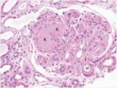 A 42 year old type I diabetic was experiencing increasing azotemia,as judged by his BUN and creatinine.His physician recommended he consult a nephrologist.A renal biopsy was recommended,and eventually performed,a representative section of which is shown in the accompanying photomicrograph.Which one of the following is the best diagnosis?   A) Acute proliferative glomerulonephritis B) Diabetic glomerulosclerosis C) Focal segmental glomerulonephritis D) Membranous nephropathy E) Mesangiocapillary (Membranoproliferative) glomerulonephritis  F) Minimal change disease G) Normal glomerulus H) Rapidly progressive glomerulonephritis (RPGN) 