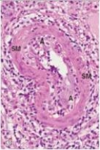 A 45 year old diabetic in chronic renal failure required kidney transplantation.A cadaveric donor was found,and a transplant was performed.After approximately 60 days,urine production from the transplanted kidney began to drop.A renal biopsy was obtained,and a representative section is shown in the accompanying photomicrograph.What type of inflammatory cell is involved in the etiology of the intimal arteritis ( A ) seen in the biopsy material?   A) B cell B) Endothelial cell C) Neutrophil D) Plasma cell E) T cell