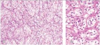 A 48 year old male seeks attention from his primary care physician because of pain in his right flank,blood in his urine,and what he thinks is a mass on his right side.The physician confirms the presence of a mass in the right flank,and refers the patient to a urologist,who removes a mass involving the right kidney.A representative section of the mass is shown in the accompanying photomicrograph.Which one of the following is the best diagnosis?   A) Adenocarcinoma B) Normal renal tubules C) Renal cell carcinoma D) Seminoma E) Transitional cell carcinoma