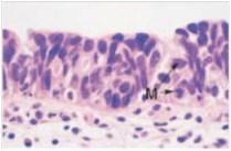 A 49 year old woman consulted her physician because of blood in her urine.She was referred to a urologist,who performed cystoscopy and bladder biopsy.A representative section of the biopsy is shown in the accompanying photomicrograph.Which one of the following is the best diagnosis?   A) Adenocarcinoma B) Invasive squamous cell carcinoma C) Invasive transitional cell carcinoma D) Papillary transitional cell carcinoma E) Transitional cell carcinoma in situ  F) Urinary tract infection,chronic