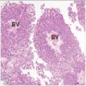 A 69 year old man consulted his physician because of blood in his urine.He was referred to a urologist,who performed cystoscopy and bladder biopsy.A representative section of the biopsy is shown in the accompanying photomicrograph.Which one of the following is the best diagnosis?   A) Adenocarcinoma B) Invasive squamous cell carcinoma C) Invasive transitional cell carcinoma D) Papillary transitional cell carcinoma E) Transitional cell carcinoma in situ  F) Urinary tract infection,chronic