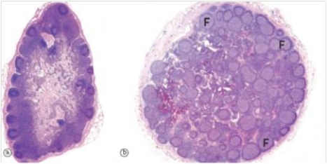 A 14 year old boy suffered from a splinter in his right finger,which became infected and inflamed.A large lymph node was found near his elbow,which his mother insisted must be removed.A representative section from the enlarged lymph node is shown at right in the accompanying photomicrograph,along with a normal lymph node that was removed at the same time.Which one of the following is the best diagnosis for the abnormal lymph node?   A) Diffuse large B cell lymphoma B) Follicular hyperplasia C) Follicular lymphoma D) Hodgkin's lymphoma E) Metastatic carcinoma