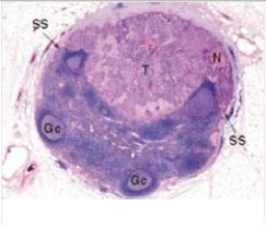 An enlarged mesenteric lymph node was removed from the abdomen of a 64 year old man at autopsy after he died in a motor vehicle accident.A representative section is shown in the accompanying photomicrograph.Which one of the following is the best diagnosis?   A) Diffuse large B cell lymphoma B) Follicular hyperplasia C) Follicular lymphoma D) Hodgkin's lymphoma E) Metastatic carcinoma