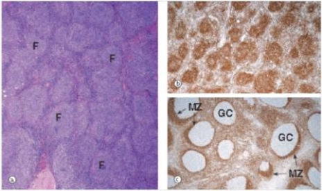 A 56 year old man noticed increased fatigue,night sweats,and enlarged lymph nodes in his right axilla.He consulted his physician,a biopsy was done,and a representative section from the biopsy is shown in the accompanying photomicrograph.The right panels show staining for Bcl-2,with a normal lymph node shown in the bottom panel (GC = germinal centre,MZ = mantle zone) .Which one of the following is the best diagnosis?   A) Diffuse large B cell lymphoma B) Follicular hyperplasia C) Follicular lymphoma D) Hodgkin's lymphoma E) Metastatic carcinoma