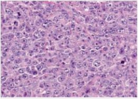 A 45 year old man with a previous history of untreated follicular lymphoma developed multiple lymph nodes that were enlarging quickly.Biopsy of one of these nodes was performed,and a representative section is shown in the accompanying photomicrograph.Which one of the following is the best diagnosis?   A) Diffuse large B cell lymphoma B) Follicular hyperplasia C) Follicular lymphoma D) Hodgkin's lymphoma E) Metastatic carcinoma