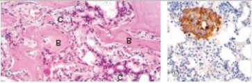 A 73 year old man complained to his physician about incapacitating back pain.An x-ray of the spine disclosed osteosclerotic lesions throughout the lumbar spine.A biopsy was performed,and a representative section is shown in photomicrograph  a .Photomicrograph  b  shows an immunoperoxidase stain.Antibodies against which one of the following antigens was likely used in the immunoperoxidase stain shown?   A) Albumin B) Cytokeratin C) Oestrogen D) Myosin E) Prostate specific antigen (PSA)   F) Troponin I