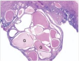 A 41 year old woman consulted her GP because of abnormal bleeding in between menstrual periods.Examination disclosed a mass visible at the cervical os.An excisional biopsy was performed,and a representative section is shown in the accompanying photomicrograph.Which one of the following is the best diagnosis?   A) Endocervical polyp B) Endometriosis C) Human papilloma virus infection (HPV)  D) Herpes simplex virus infection E) Severe dysplasia/carcinoma in situ
