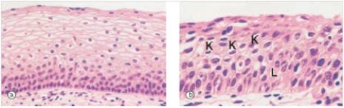 A 22 year old woman was seen by her GP for follow-up after an abnormal Pap smear.A biopsy of the cervix was done,and a representative section is shown in the accompanying photomicrograph.Which one of the following is the best diagnosis?   A) Endocervical polyp B) Endometriosis C) Human papilloma virus infection (HPV)  D) Herpes simplex virus infection E) Severe dysplasia/carcinoma in situ