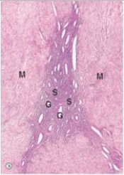 A 46 year old mother of three saw her GP who noticed a symmetrically enlarged uterus with no masses.A pregnancy test was negative.Since she already had three children,the woman elected to have a vaginal hysterectomy.A histological section from the myometrium is shown in the accompanying photomicrograph.Which one of the following is the best diagnosis?   A) Adenomyosis B) Endometriosis C) Endometrial polyp D) Endometrioid carcinoma E) Leiomyoma