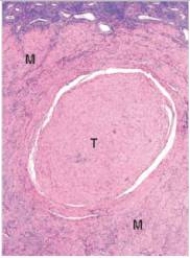 A 38 year old woman is seen by her GP for increasing pelvic pain and abnormal uterine bleeding.The GP palpates several firm masses in the uterus.The patient is referred to a gynaecologist who recommends and eventually performs a vaginal hysterectomy.A representative section of the uterus is shown in the accompanying photomicrograph.Which one of the following is the best diagnosis?   A) Adenomyosis B) Endometriosis C) Leiomyoma D) Leiomyosarcoma E) Thrombus