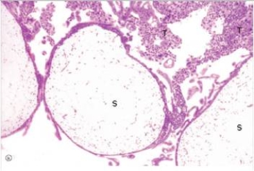 A 27 year old woman suspected she was pregnant,and performed a home pregnancy test,which was positive.However,a few weeks later,when she had her first ultrasound,no foetus was detected.Instead,the uterus was filled with round,grape-like masses.A dilation and curettage (D&C) was then performed.Tissue from the procedure was sent to surgical pathology,and a representative section from this material is shown in the accompanying photomicrograph.Which one of the following is the best diagnosis?   A) Endometrial carcinoma B) Endocervical polyp C) Endometrial polyp D) Hydatidiform mole E) Infection with hydatid tapeworm