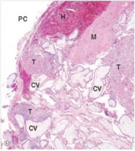 A 24 year old woman came to the emergency department with severe abdominal pain and vaginal bleeding.A physician palpated a mass in the right fallopian tube.A pregnancy test was positive.She was taken to the OR for emergency laparotomy (exploration of the abdomen) and the right fallopian tube and mass were removed.A representative section is shown in the accompanying photomicrograph.Which one of the following is the best diagnosis?   A) Acute salpingitis B) Choriocarcinoma C) Ectopic pregnancy D) Endometrial carcinoma E) Endometriosis  F) Tubo-ovarian abscess