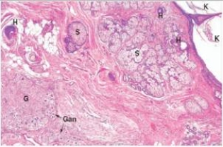 A 20 year old woman consulted the Students' Health Service GP at her university because of an enlarging abdomen and abdominal fullness.Friends had been asking her if she was pregnant,but she was not sexually active.The physician palpated a large mass in the right ovary.She underwent an exploratory laparotomy (abdominal exploration) ,and an 8 cm tumour was removed,along with the right ovary.When sectioned,the tumour containing a mass of oily hair.A representative section is shown in the accompanying photomicrograph.Which one of the following is the best diagnosis?   A) Brenner tumour B) Cystic teratoma C) Mucinous cystadenoma D) Mucinous cystadenocarcinoma E) Serous cystadenoma  F) Serous cystadenocarcinoma