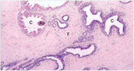 A 40 year old woman consulted her GP because she felt a lump in her breast.The GP found the lump and felt that,since the mass seemed to change in size with her menstrual periods,it was likely a benign process.Because she had a sister with breast cancer,and to avoid excessive worry on the part of the patient,a biopsy was performed.A representative section is shown in the accompanying photomicrograph.Which one of the following is the best diagnosis?   A) Ductal carcinoma in situ B) Fibroadenoma C) Fibrocystic change D) Gynaecomastia E) Infiltrating ductal carcinoma  F) Infiltrating lobular carcinoma G) Lobular carcinoma in situ