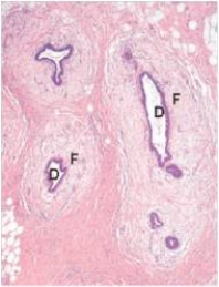 A 55 year old man was undergoing oestrogen treatment for his prostatic adenocarcinoma.He noticed bilateral swelling in his breasts.Because of the cosmetic nature of the disorder,the bilateral breast tissue was removed,and a representative section is shown in the accompanying photomicrograph.Which one of the following is the best diagnosis?   A) Ductal carcinoma in situ B) Fibroadenoma C) Fibrocystic change D) Gynaecomastia E) Infiltrating ductal carcinoma  F) Infiltrating lobular carcinoma G) Lobular carcinoma in situ