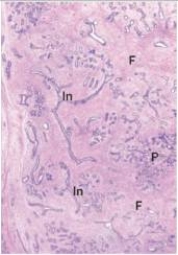 A 23 year old woman noted a firm,mobile,2 cm mass in her right breast.Alarmed,she consulted her GP,and it was removed.A representative section of the mass is shown in the accompanying photomicrograph.Which one of the following is the best diagnosis?   A) Ductal carcinoma in situ B) Fibroadenoma C) Fibrocystic change D) Gynaecomastia E) Infiltrating ductal carcinoma  F) Infiltrating lobular carcinoma G) Intraductal papilloma H) Lobular carcinoma in situ