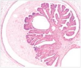 A 28 year old woman consulted her GP because she felt a mass in her breast,just below the nipple.She had also noted a bloody discharge from the same nipple,and was quite concerned.The GP told her it was likely benign,and the mass was later removed surgically.A representative section is shown in the accompanying photomicrograph.Which one of the following is the best diagnosis?   A) Ductal carcinoma in situ B) Fibroadenoma C) Fibrocystic change D) Gynaecomastia E) Infiltrating ductal carcinoma E.Infiltrating ductal carcinoma F) Infiltrating lobular carcinoma G) Intraductal papilloma H) Lobular carcinoma in situ