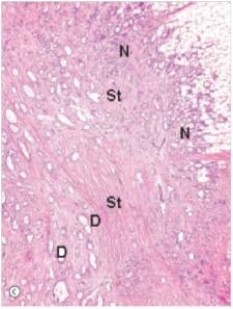 A 58 year old woman noted a mass in her breast,for which she sought advice from her GP.The physician felt the mass,but also noticed skin retraction over the lesion.A biopsy was done,revealing the histological appearance shown in the accompanying low power photomicrograph.Which one of the following is the best diagnosis?   A) Ductal carcinoma in situ B) Fibroadenoma C) Fibrocystic change D) Gynaecomastia E) Infiltrating ductal carcinoma  F) Infiltrating lobular carcinoma G) Intraductal papilloma H) Lobular carcinoma in situ