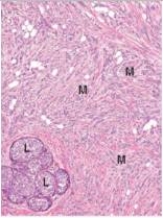 A 49 year old woman found a mass in each of her breasts.After consultation with a surgeon,bilateral biopsies were done,revealing the histology seen in the accompanying photomicrograph.How would you classify the malignant cells (M) seen?   A) Ductal carcinoma in situ B) Fibroadenoma C) Fibrocystic change D) Gynaecomastia E) Infiltrating ductal carcinoma  F) Infiltrating lobular carcinoma G) Intraductal papilloma H) Lobular carcinoma in situ