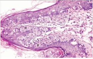 A 63 year old woman consulted her GP because of a rash on her left nipple.It had been weeping clear fluid for some weeks,and was reddened.A biopsy was done,and a representative section is shown in the accompanying photomicrograph.Which one of the following conclusions is warranted?   A) Application of a hydrocortisone cream is indicated B) She has an underlying breast carcinoma C) She needs to apply sunscreen while sunbathing to avoid such basal cell carcinomas D) The lesion should heal on its own E) The patient is pregnant