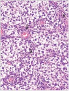 A 28 year old man sees his GP about a 2 cm firm mass in his right testis.The GP examines it and recommends immediate removal of the tumour.The testis and spermatic cord are surgically removed shortly thereafter,and a representative section of the tumour is shown in the accompanying photomicrograph.Which one of the following is the best diagnosis?   A) Embryonal carcinoma B) Immature teratoma C) Seminoma D) Torsion of the testis E) Yolk sac tumour