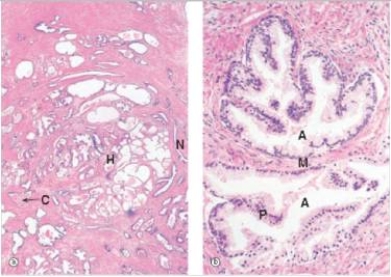A 55 year old man consults his GP for trouble with urination.He has difficulty both starting and stopping his stream.He often has to get up 2-3 times per night to urinate.The physician palpates a nodular prostate,and a needle biopsy is performed,to rule out carcinoma.A representative section is shown in the accompanying photomicrograph.Which one of the following is the best diagnosis?   A) Acute prostatitis B) Chronic prostatitis C) Benign prostatic hyperplasia (BPH)  D) Prostatic adenocarcinoma E) Prostatic intraepithelial neoplasia
