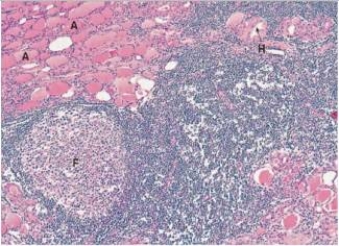 A 36 year old woman noticed a lump in her neck.When seen by her GP,she also noted that she had been fatigued lately.He palpated a nodular thyroid that was somewhat tender.Because of the cosmetic defect that the patient felt,the thyroid was removed.A representative section is shown in the accompanying photomicrograph.Which one of the following is the best diagnosis?   A) Follicular carcinoma B) Graves' disease C) Hashimoto's thyroiditis D) Multinodular goitre E) Papillary carcinoma  F) Thyroid adenoma