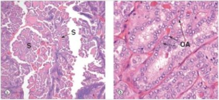 A 24 year old woman noted a swelling in her neck.She sought advice from her GP who also noticed some enlarged cervical lymph nodes.The GP recommended she have her thyroid gland surgically removed,which was accomplished within the week.A representative section of the gland is shown in the accompanying photomicrograph.Which one of the following is the best diagnosis?   A) Follicular carcinoma B) Graves' disease C) Hashimoto's thyroiditis D) Multinodular goitre E) Papillary carcinoma  F) Thyroid adenoma