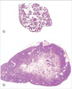A 57 year old woman with diabetes and chronic renal failure was experiencing several bouts with kidney stones.These were proven to be derived from calcium,and her serum calcium level was found to be high normal.Her parathyroid glands were all removed,and a representative gland is shown in the bottom photomicrograph,compared to a normal parathyroid (from another patient) in photo (a) .Which one of the following is the best diagnosis?   A) Metastatic adenocarcinoma B) Parathyroid adenoma C) Parathyroid carcinoma D) Parathyroid hyperplasia E) Pituitary adenoma