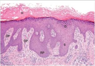 The thickening of the epidermis in this photomicrograph is due primarily to enlargement of which one of the following epidermal layers?   A) Dermis B) Dermal papillae C) Keratin layer (hyperkeratosis)  D) Rete ridges (acanthosis) 