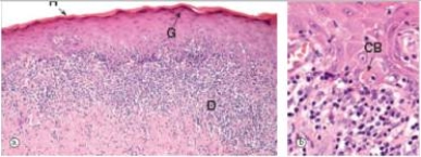 A 45 year old woman noticed a whitish patch on the skin of her forearm.Her GP biopsied the lesion,which a pathologist eventually diagnosed as lichen planus.A representative section is shown in the accompanying photomicrograph.How would you characterise the structure marked  CB  in the high power photo on the right?   A) Apoptotic body B) Artifact C) Fungus D) Mite E) Inflammatory cell