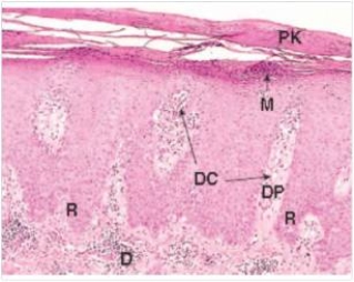 A 35 year old woman had silver patches surrounded by erythema (redness) on her elbows and knees.A biopsy was done,and a representative section is shown in the accompanying photomicrograph.Which one of the following is the best diagnosis?   A) Basal cell carcinoma B) Lichen planus C) Molluscum contagiousum D) Psoriasis E) Squamous cell carcinoma  F) Viral warts