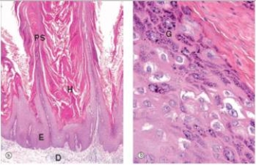 A 4 year old boy developed raised bumps on his fingers.His friends at his pre-school had similar lesions.A biopsy of one of the lesions is shown in the accompanying photomicrograph.Which one of the following is the best diagnosis?   A) Basal cell carcinoma B) Lichen planus C) Molluscum contagiousum D) Psoriasis E) Squamous cell carcinoma  F) Viral warts