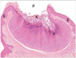 A 4 year old boy developed raised bumps on his fingers.His friends at his pre-school had similar lesions.A biopsy of one of the lesions is shown in the accompanying photomicrograph.Which one of the following is the best diagnosis?   A) Basal cell carcinoma B) Lichen planus C) Molluscum contagiousum D) Psoriasis E) Squamous cell carcinoma  F) Viral warts