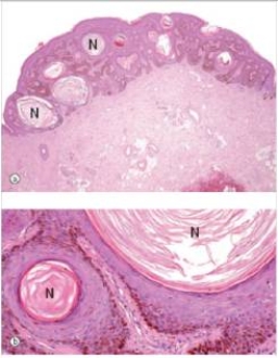 A 75 year old man had several brown,raised lesions on his arms.One of them began to bleed,after he snagged it while putting on his shirt.Fearing melanoma,he consulted his GP,who removed it.A representative section is shown in the accompanying photomicrograph.Which one of the following is the best diagnosis?   A) Actinic keratosis B) Basal cell carcinoma C) Compound naevus D) Malignant melanoma E) Seborrhoeic keratosis  F) Superficial spreading malignant melanoma G) Squamous cell carcinoma
