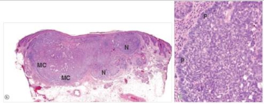 A 39 year old female consulted her GP because of a small,non-healing ulcer that appeared on her nose.Upon examination,she was overly tanned,and had a 0.8 cm diameter lesion with pearly white raised edges on the right side of her nose.The lesion was completely excised.A representative section is shown in the accompanying photomicrograph.Which one of the following is the best diagnosis?   A) Actinic keratosis B) Basal cell carcinoma C) Compound naevus D) Malignant melanoma E) Seborrheic keratosis  F) Superficial spreading malignant melanoma G) Squamous cell carcinoma