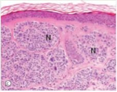 How would you classify the pigmented lesion shown in the accompanying photomicrograph?   A) Intradermal naevus B) Junctional naevus C) Malignant melanoma D) Seborrheic keratosis E) Superficial spreading melanoma