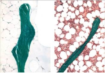 A 55 year old woman fell while touring London.She sustained a fracture of her humerus,just below the head of the humerus.The fracture was surgically repaired and sample of bone tissue was taken and sent to pathology.The sample is shown in the accompanying image with normal bone on the left for comparison.Both sections are undecalcified,and are stained with Goldner's trichrome,which stains uncalcified osteoid pink,and calcified matrix green.Which one of the following diagnoses is most likely correct?   A) Osteogenic sarcoma B) Osteoporosis C) Osteomalacia D) Osteomyelitis E) Paget's disease of bone