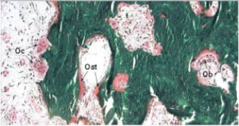 A 70 year old man complained of headache to his GP.He thought something was seriously wrong,because he had noticed his hat size was also increasing,and he feared underlying bone cancer.A biopsy of his skull was performed,and is compared with normal bone on the left.Both sections are undecalcified,and are stained with Goldner's trichrome,which stains uncalcified osteoid (Ost) pink,and calcified matrix green.Which one of the following diagnoses is most likely correct?     A) Osteogenic sarcoma B) Osteoporosis C) Osteomalacia D) Osteomyelitis E) Paget's disease of bone