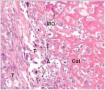 A 15 year old boy was kicked in the leg during a football game.The coach put ice on it,and he seemed ok,but three weeks later,he still had pain above his knee that kept him awake at night.An x-ray revealed a large mass in the femur.A biopsy was performed,a representative section of which is shown in the accompanying photomicrograph.Which one of the following is the best diagnosis?   A) Chondrosarcoma B) Fracture,with non-union C) Osteogenic sarcoma D) Osteoid osteoma E) Paget's disease of bone