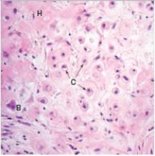 A 69 year old man was seen by his GP for pain in the right hip.An x-ray revealed a large mass involving the pelvis that was pressing on the joint.A biopsy was performed,and a representative section is shown in the accompanying photomicrograph.Which one of the following is the best diagnosis?   A) Chondrosarcoma B) Fracture,with non-union C) Osteogenic sarcoma D) Osteoid osteoma E) Paget's disease of bone