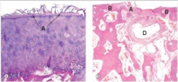 A 55 year old former long-distance runner consulted his GP because of pain in his knee.The joint space was severely narrowed,and the pain was  intolerable .Knee replacement was done.A sample of the tissue removed is shown in the accompanying photomicrograph.Which one of the following is the best diagnosis?   A) Gout B) Osteomalacia C) Osteoporosis D) Osteoarthritis E) Rheumatoid arthritis