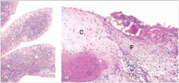 A 39 year old woman consulted her GP because of bilateral pain in her knees.The knees appeared swollen.The joint space was markedly decreased.Knee replacement was done,and representative tissue removed during replacement surgery is shown in the accompanying photomicrograph.   A) Gout B) Osteomalacia C) Osteoporosis D) Osteoarthritis E) Rheumatoid arthritis
