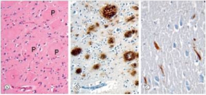 A 67 year old man,who had been an accounting executive for a large manufacturing firm most of his career,began to have problems driving in his city.He frequently became lost.He was also having difficulties finding the proper word to describe simple things,like a fork,or a pair of pliers.A CT scan showed atrophy of cerebral cortex,and a relative increase in size of the lateral ventricles.He died of an apparent heart attack a few months after the onset of symptoms,and his wife requested an autopsy.Representative sections are shown in the accompanying photomicrographs.Which one of the following is the best diagnosis?   A) Alzheimer's disease B) Meningitis C) Parkinson's disease D) Dementia with Lewy bodies E) Creutzfeldt-Jakob disease