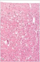 The wife of a 55 year old man noticed that he exhibited strange behaviour such as fits of rage and moments of confusion.Together,they consulted a GP who also noticed some neurologic abnormalities such as rigidity in the upper extremities.A representative section of the brain biopsy is shown in the accompanying photomicrograph.Which one of the following is the best diagnosis?   A) Alzheimer's disease B) Meningitis C) Parkinson's disease D) Dementia with Lewy bodies E) Creutzfeldt-Jakob disease