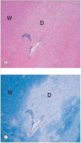 A 32 year old woman suddenly developed paraplegia in her right leg.This caused her to crash her car.A coroner's autopsy was ordered.A representative section from the area of the internal capsule in the brain disclosed the findings seen in the accompanying photomicrographs,with H&E in the upper photo (a) and a Luxol fast blue myelin stain in the lower photo (c) .Which one of the following is the best diagnosis?   A) Glioblastoma B) Herpes simplex virus encephalitis C) Infarction D) Meningioma E) Multiple sclerosis