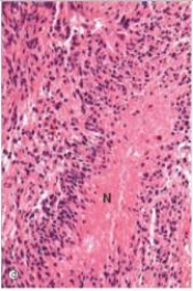 A 45-year-old woman woke up in the morning with a severe headache.She did not recognize her husband of 20 years.She then experienced a grand mal seizure.Her husband called an ambulance,and she was taken to the hospital.A CT scan disclosed a large tumour,deep in the cerebrum,that crossed the midline near the corpus callosum.Necrosis was evident throughout the tumour.A brain biopsy of a portion of the tumour was done and a representative section is shown in the accompanying photomicrograph.Which one of the following is the best diagnosis?   A) Ependymoma B) Glioblastoma C) Meningioma D) Medulloblastoma E) Oligodendroglioma