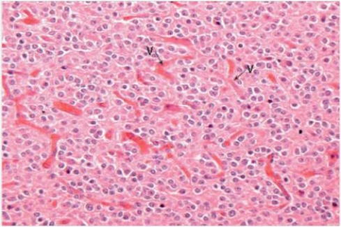 A 44 year old man began exhibiting bizarre personality changes,noted first by his wife.She brought him to the local Emergency Department,where a neuropsychiatrist ordered a CT scan.The scan revealed a 3 cm,well-demarcated tumour in the frontal lobes.Calcification was evident within the tumour.A neurosurgeon was consulted,and the tumour was later removed without incident.The patient returned to his normal state.A representative section of the tumour is shown in the accompanying photomicrograph.Which one of the following is the best diagnosis?   A) Ependymoma B) Glioblastoma C) Meningioma D) Multiple sclerosis E) Oligodendroglioma
